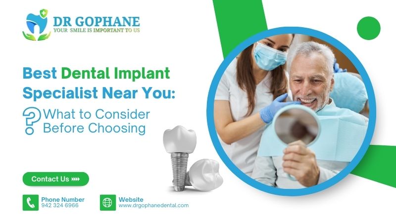 Best Dental Implant Specialist Near You: What to Consider Before Choosing