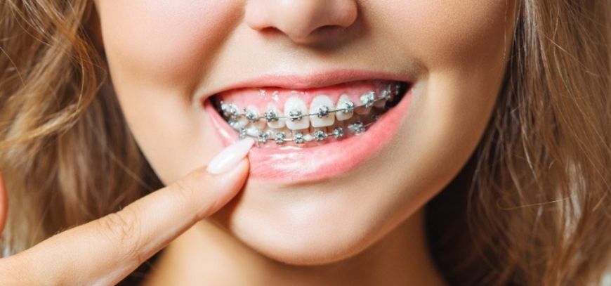 Braces Treatment in Yavatmal