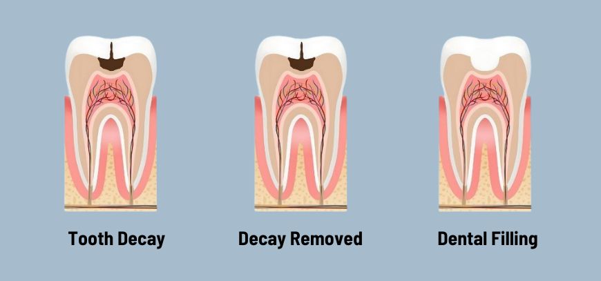 Cavity Filling in Yavatmal