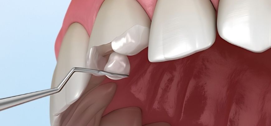 Cosmetic Dental Treatment in Yavatmal