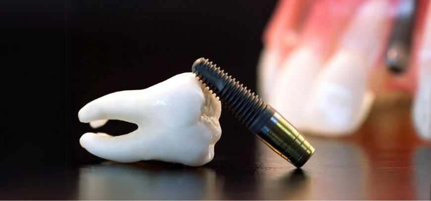 Dental Implants in Yavatmal