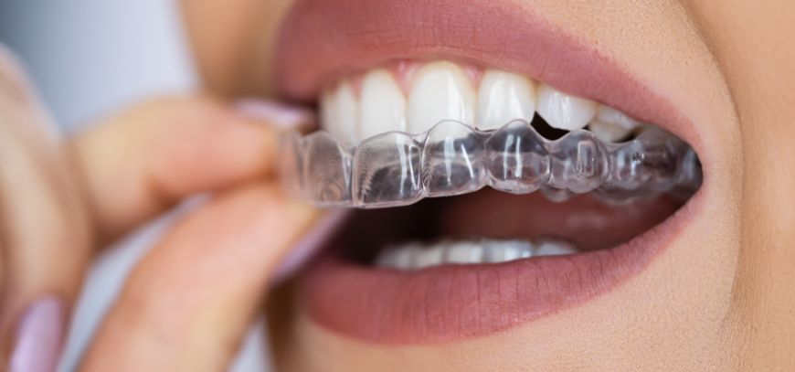 Invisalign Treatment in Yavatmal