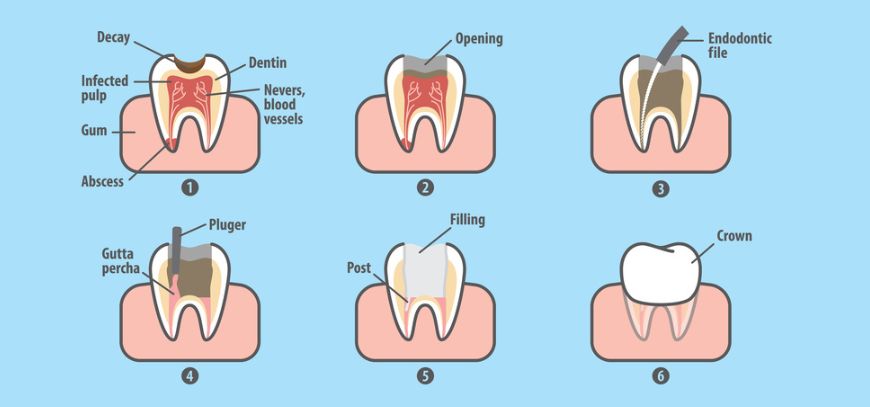 Root Canal Treatment in Yavatmal