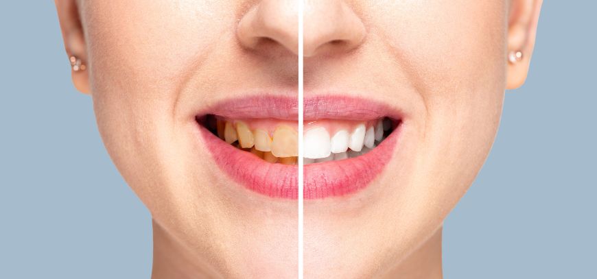 Teeth Whitening in Yavatmal